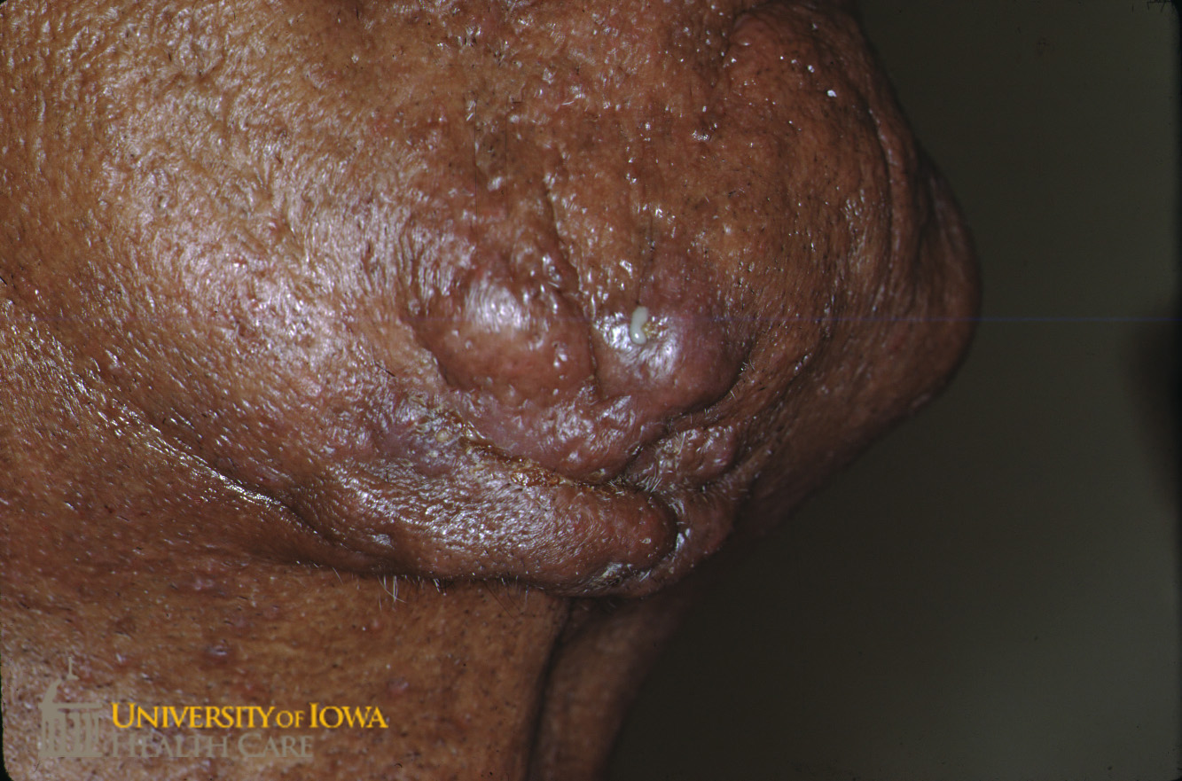Perifollicular hyperpigmented papules and keloidal nodules with purulent drainage on the beard area. (click images for higher resolution).